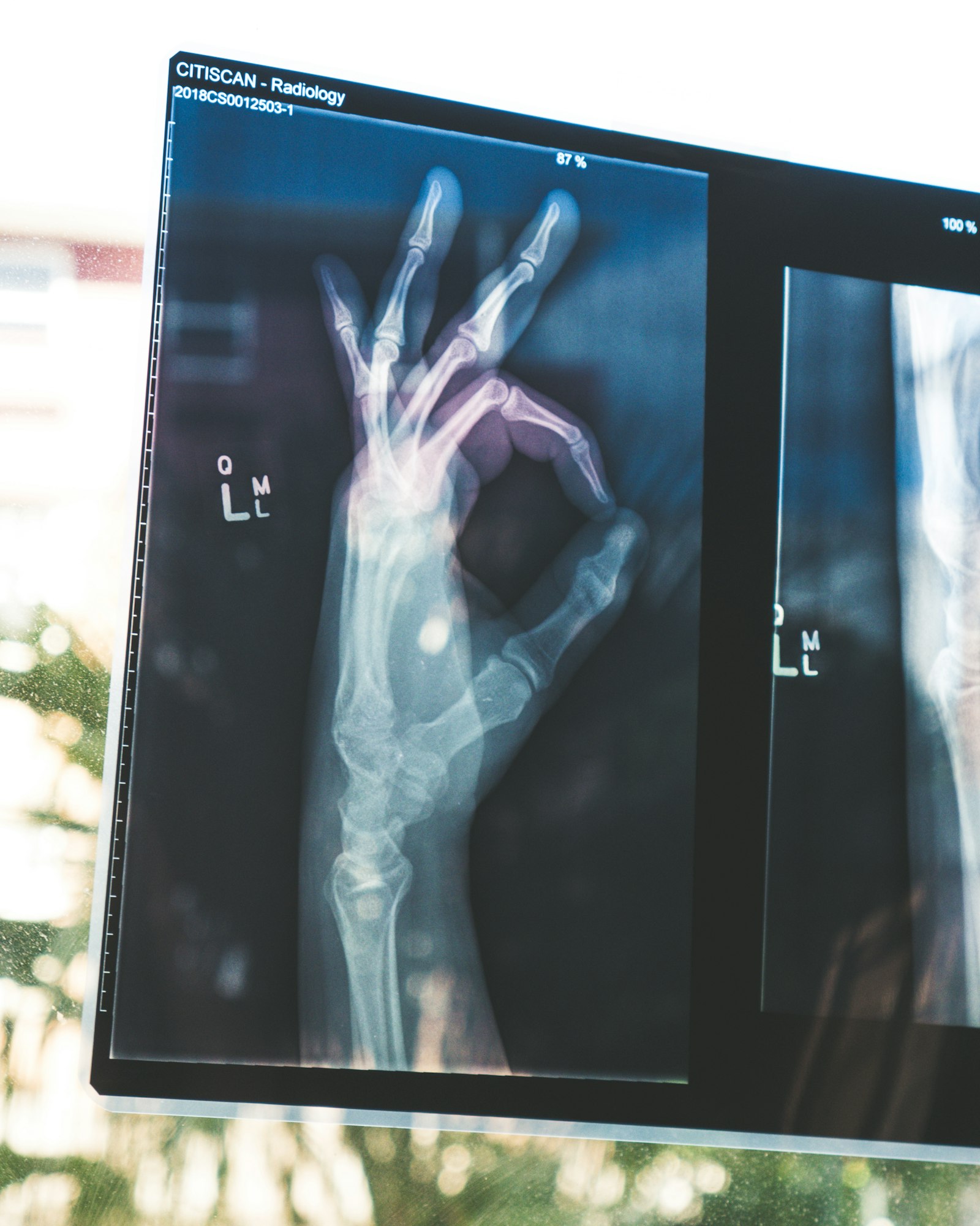 Cauda Equina Syndrome Claims